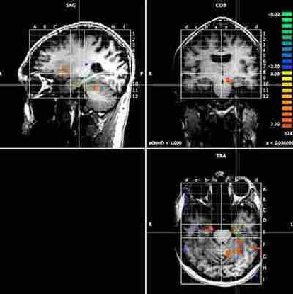 La resonancia magnética nuclear muestran la activación en la zona entorrinal.
