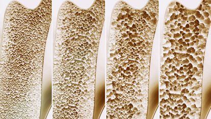 La cuatro etapas de la osteoporosis. 