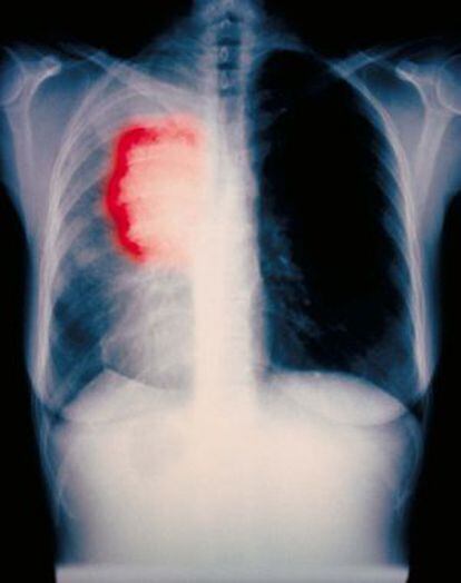 El cáncer de pulmón es candidato al tratamiento con inmunoterapia.