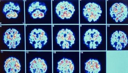  Serie de imágenes del cerebro de un paciente con alzhéimer obtenidas mediante PET. 
