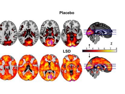 La imagen muestra como, con los ojos cerrados, intervienen muchas más áreas del cerebro en la experiencia visual bajo los efectos del LSD (abajo) que con el placebo.