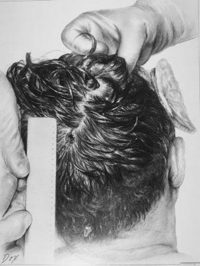 Reconstrucción de un dibujante, basada en las fotos de la autopsia, de la herida en la cabeza del presidente Kennedy: el cráneo abierto en la parte derecha.