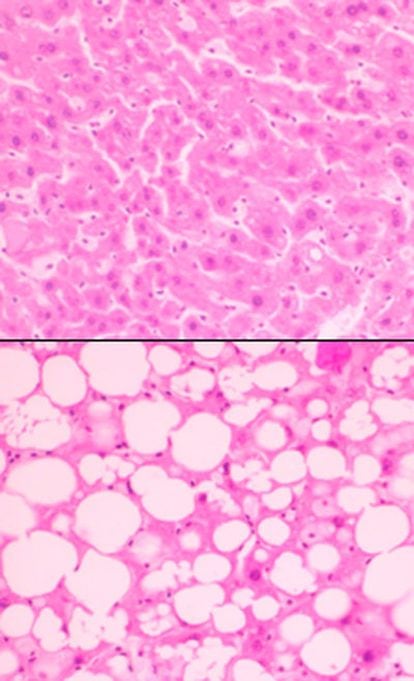 Arriba, células del hígado sanas; abajo, con vacuolas de grasa -la de los ratones que tomaron CLA trans-.