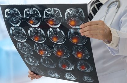 Un neurólogo observa los resultados de una resonancia magnética de un paciente que ha sufrido un ictus.