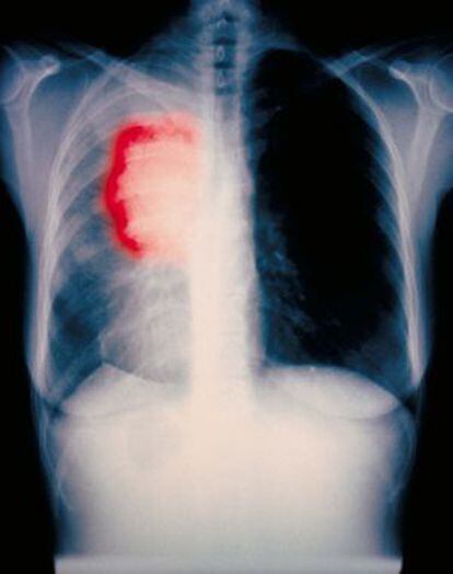 Radiografía de un paciente fumador.