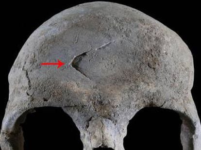 Fractura en el cráneo de uno de los dos individuos analizados.