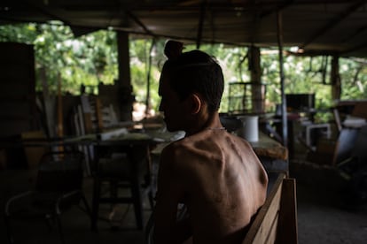 Anderson Chacón, un habitante de la ciudad de Valencia, en Venezuela, padece diabetes y desnutrición.