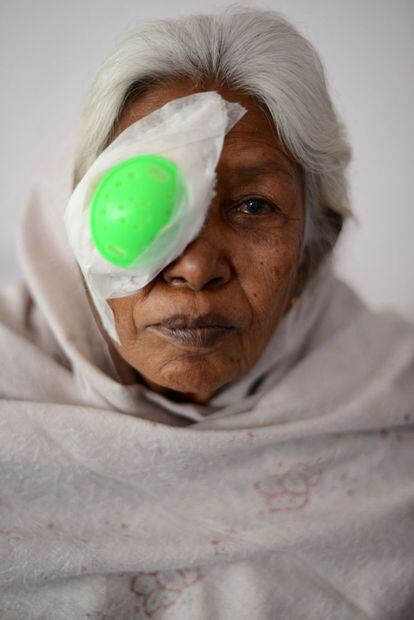 Una enferma de lepra ha sido operada en un hospital de Bangalore de problemas de vista, unos de los primeros que se manifiestan en esta enfermedad.